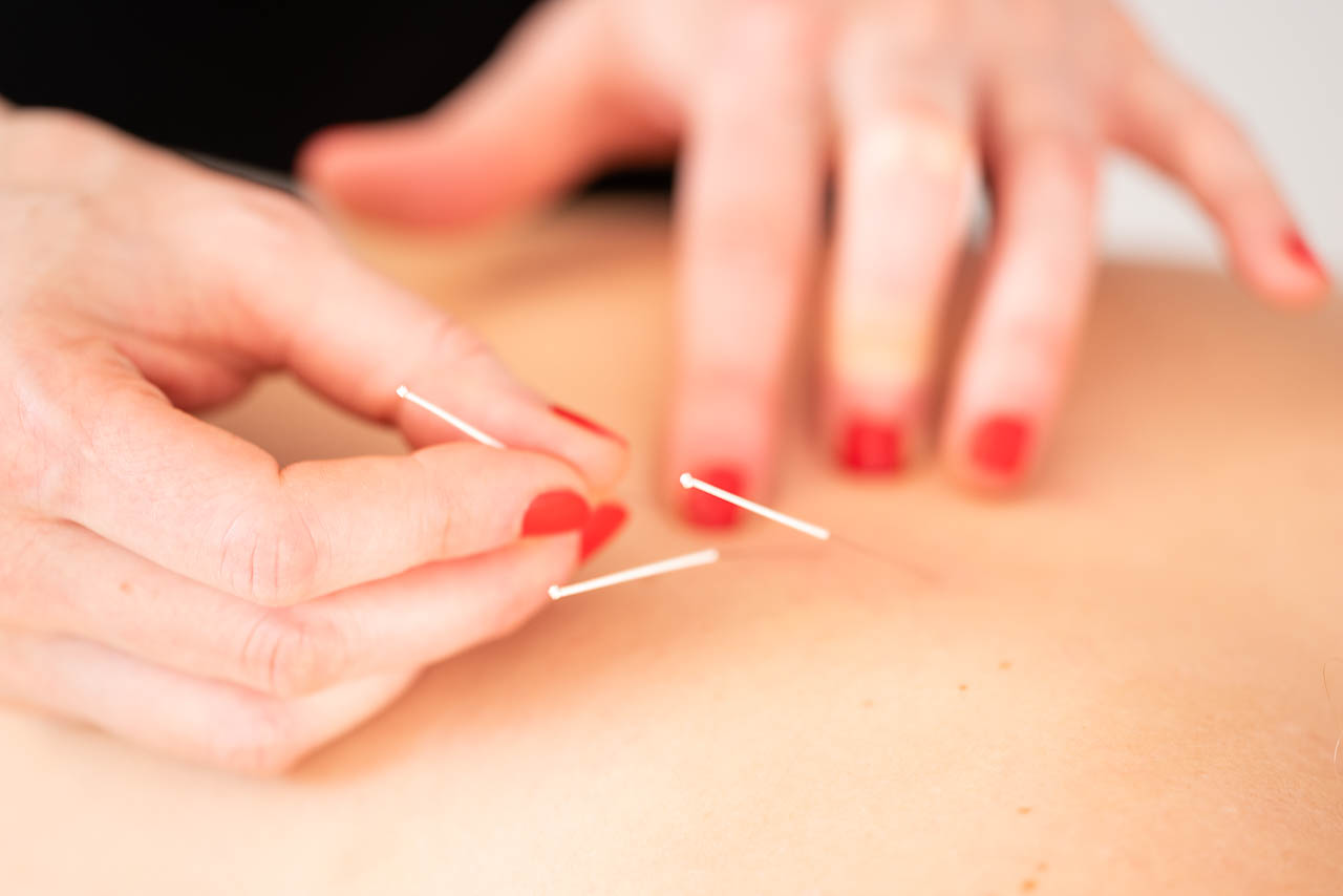 Akupunktur, TCM, Therapie, Massage